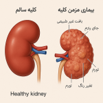 عوارض دیالیز